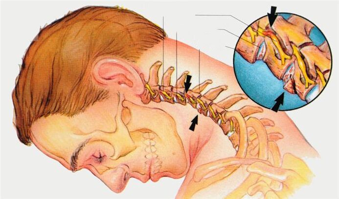 Cervical spine injury